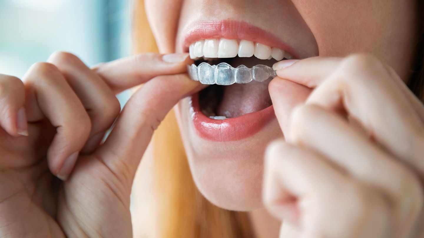 Navigating Invisalign Treatment Cost in Parel Mumbai for a Perfect Smile