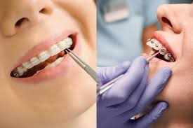 What orthodontists in Smyrna offer clear ceramic braces?