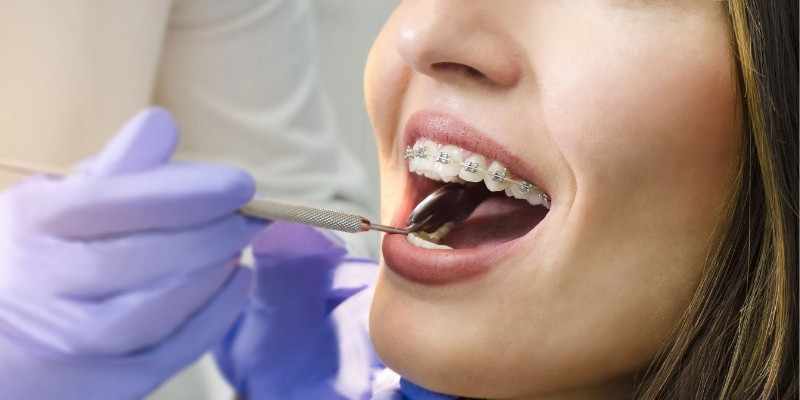 Braces Treatment in Your 30s and 40s: Is It Worth It?