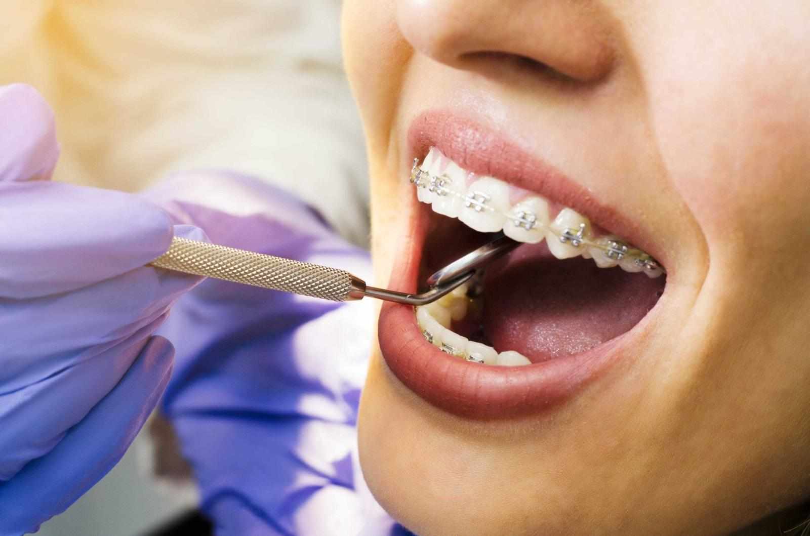 Orthodontic Treatment Options Compared: Braces, Clear Aligners, and Beyond
