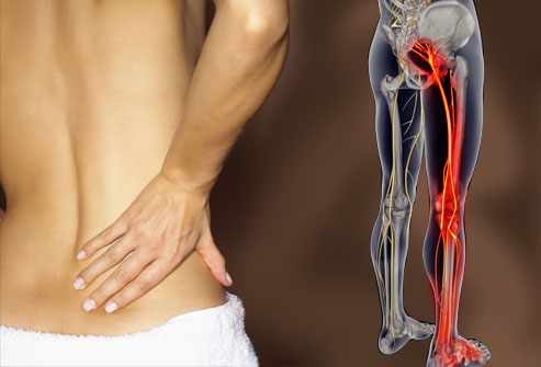 How to Treat Sciatic Pain Naturally in the US & Canada
