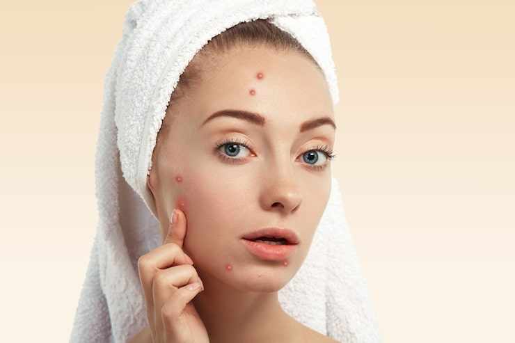 Acne Treatment in Gurgaon: Effective Solutions for Clear, Healthy, and Glowing Skin