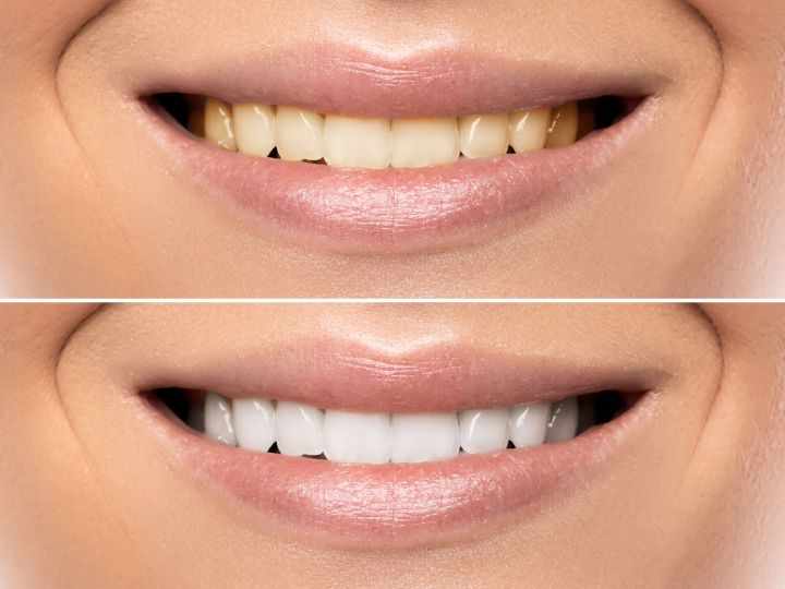 How Much Does Teeth Whitening Cost Compared to Other Smile Enhancements?