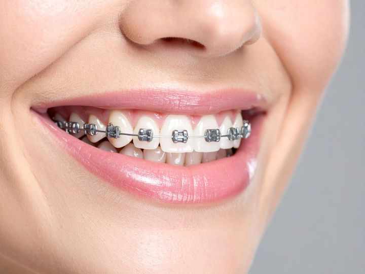 Why braces are still the most reliable way to fix alignment