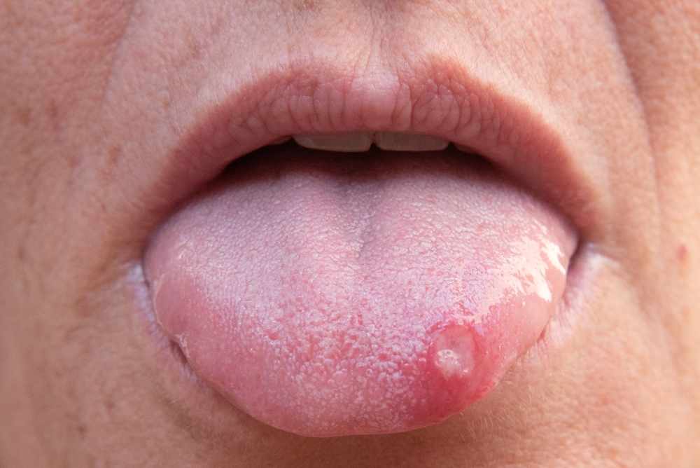 How Tongue Warts Develop: Risk Factors and Early Signs