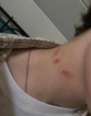 50)Bitten in my sleep