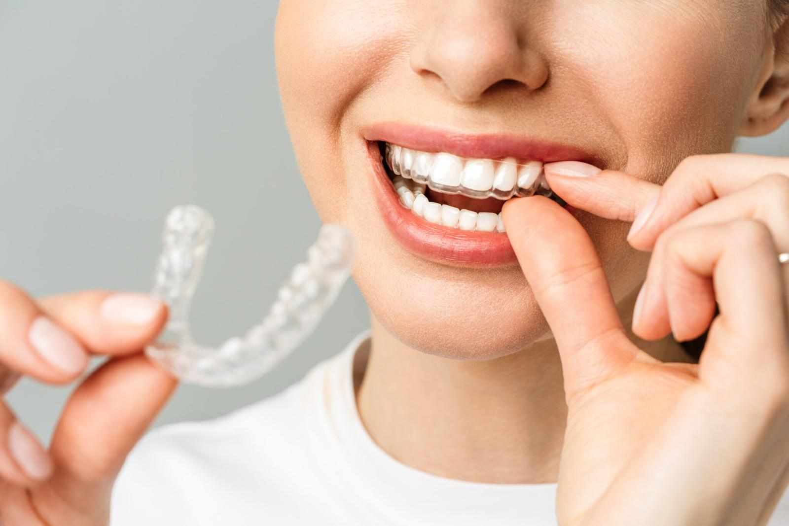 Straighten Your Smile the Modern Way: Invisible Braces Treatment in Badlapur