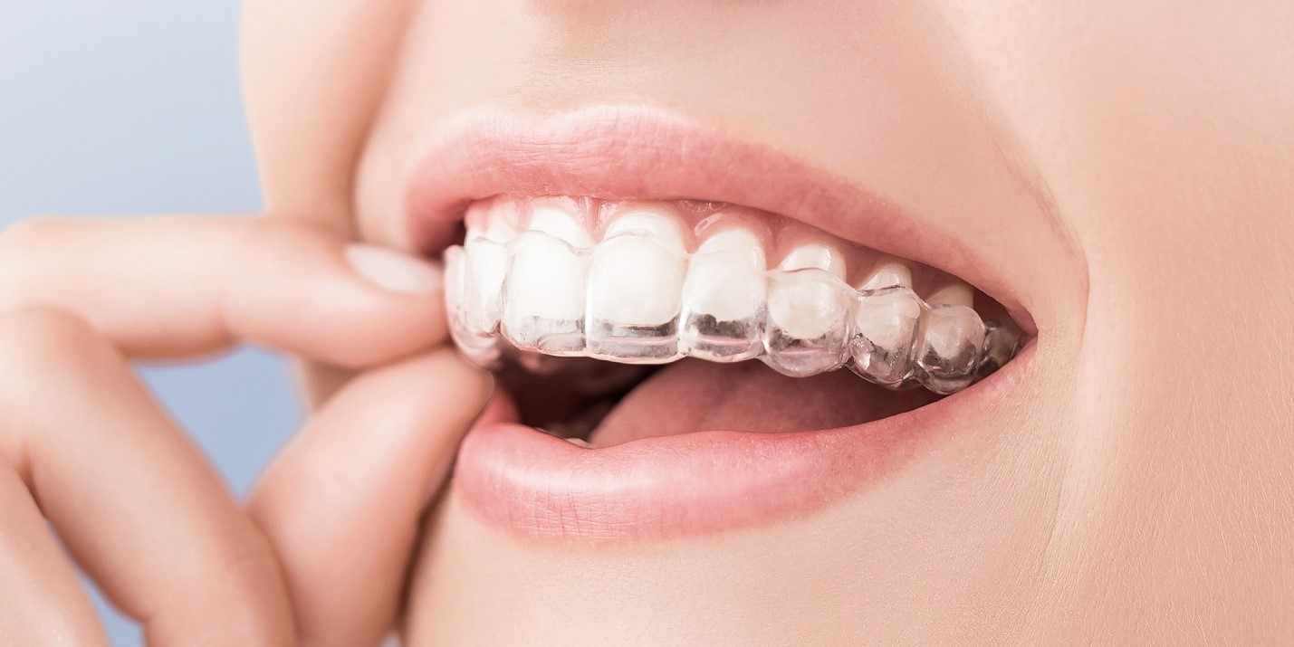 Finding the Right Path for Invisible Aligners in Badlapur
