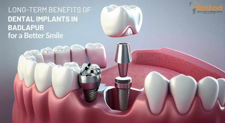 Long-Term Benefits of Dental Implants in Badlapur for a Better Smile
