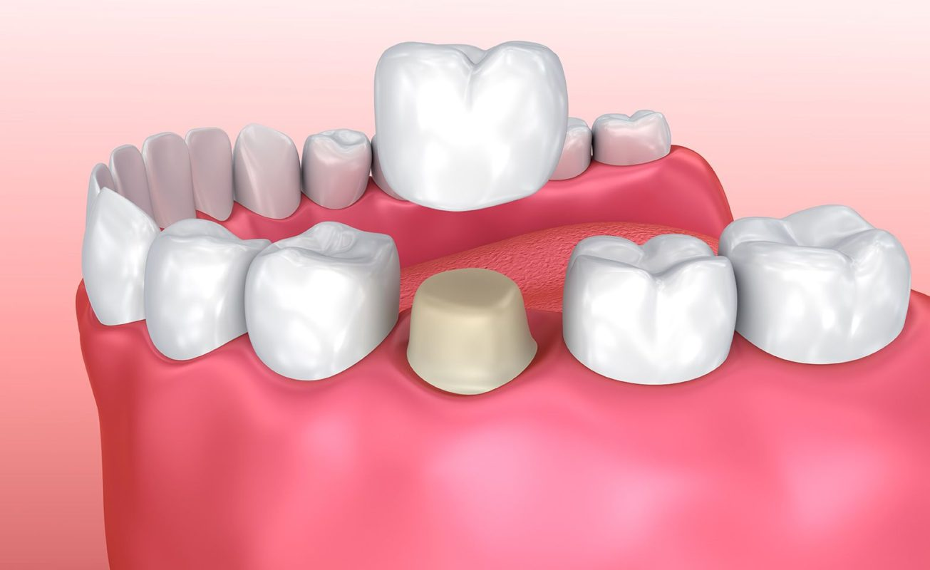 Why Families Prefer Dental Crowns Service in Badlapur for Stronger Long-Lasting Teeth