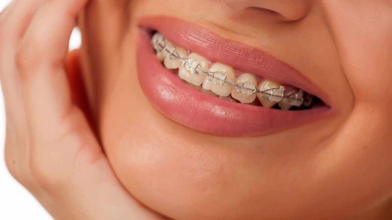 Invisible Braces in Jaipur