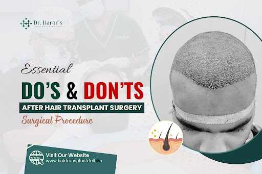 Essential Do's and Don'ts After Hair Transplant Surgical Procedure
