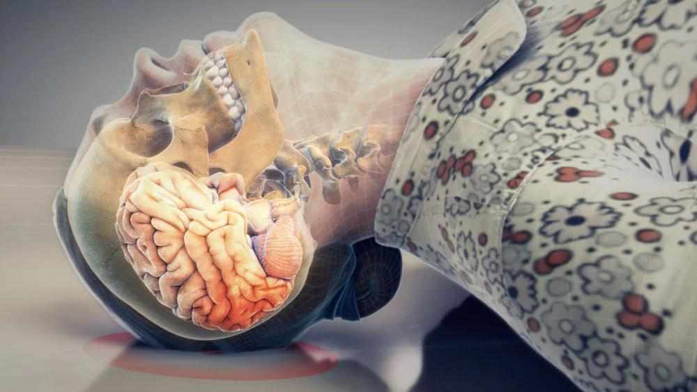 Slip and Fall with Skull/Brain Injuries | MediVisuals + High Impact