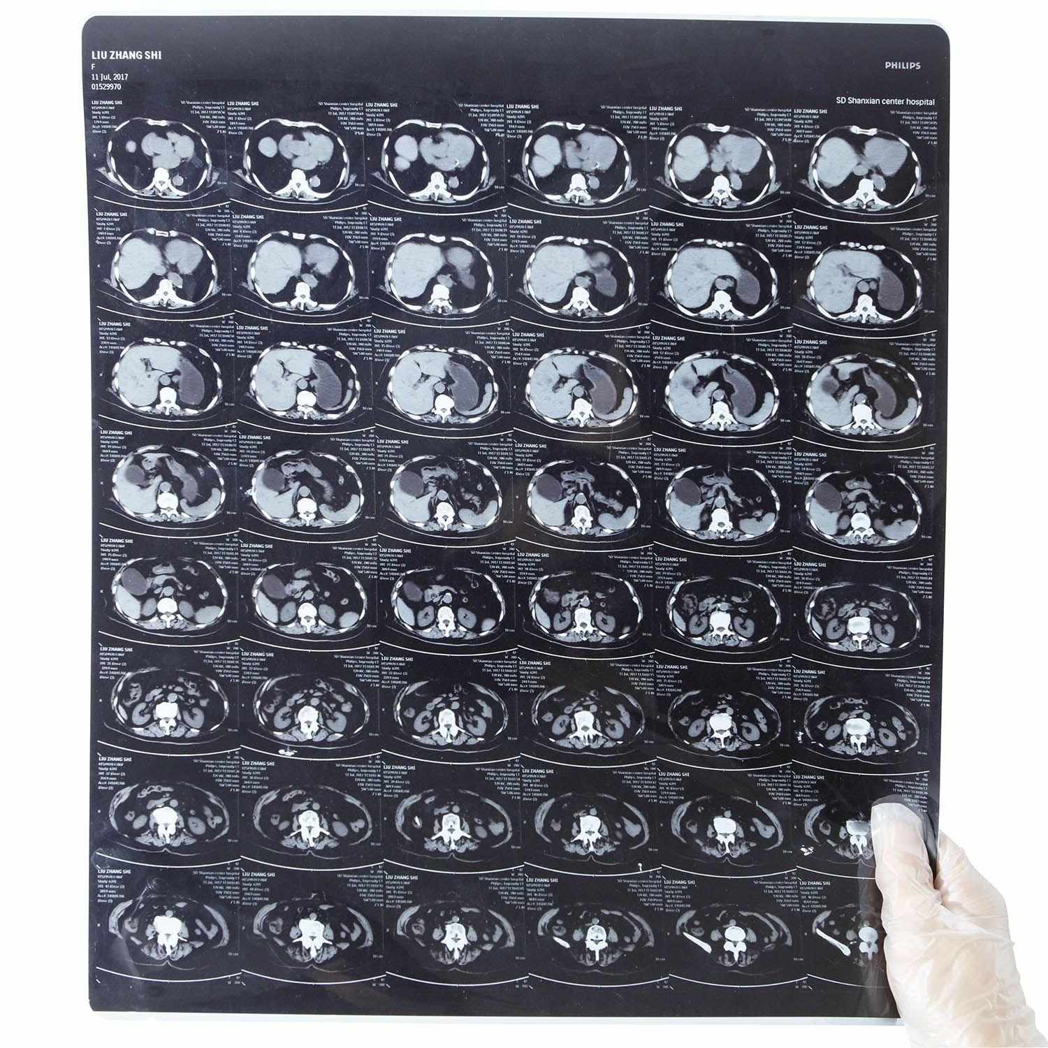 Medical Blue Based Laser Print Medical Dry X-ray Film - Inkjet Dry Film and A3 Inkjet Dry Film