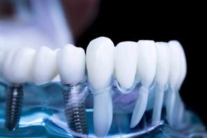 Dental Implants Ryde for Full Mouth Restoration Solutions