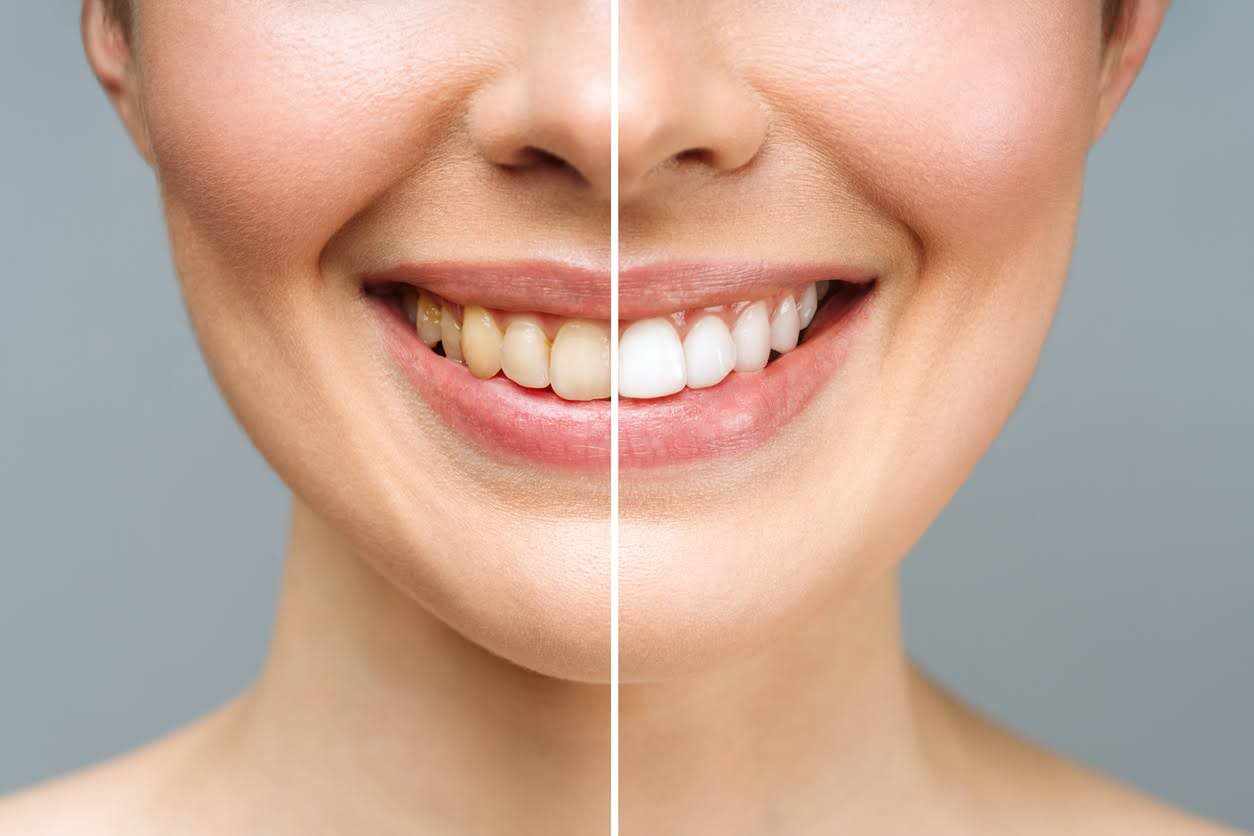 Tips for Safe Teeth Whitening Services that Deliver Better Results