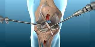 Knee Arthroscopy - Orthoist