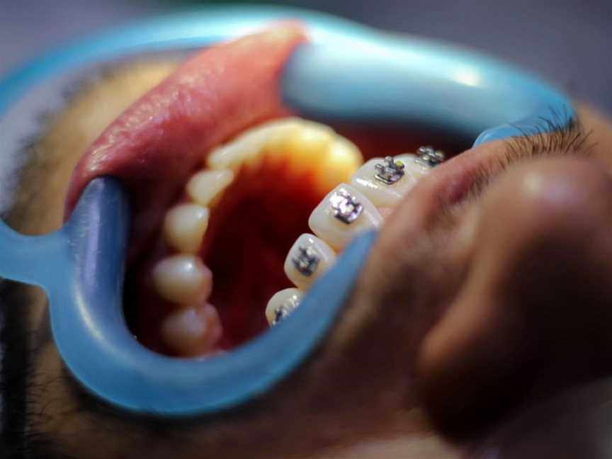 Dental Braces Adelaide for Healthy Aligned Smiles