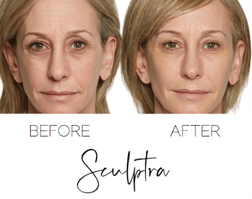 How Fort Lauderdale Med Spas Are Using Sculptra for Natural-Looking Results