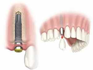 Why Dental Implants Are the Best Choice for Tooth Replacement