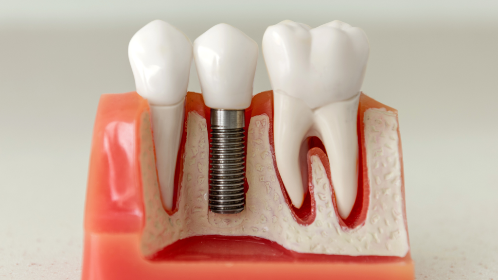 Can You Get Dental Implants on a Budget?