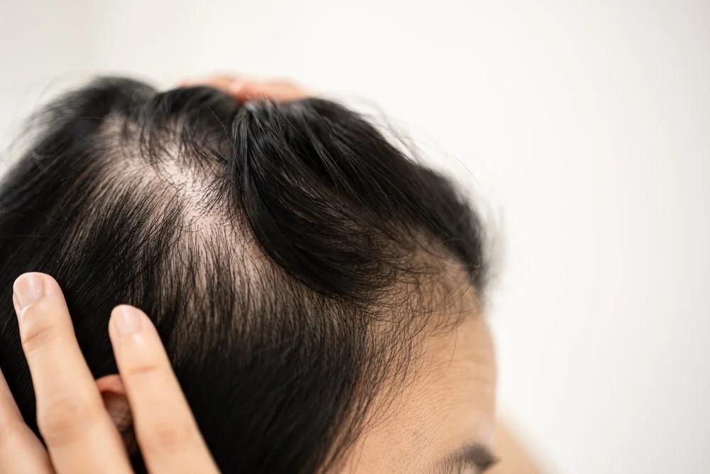Alopecia Areata Market Trends, Forecast, and Key Players (2024-2032)