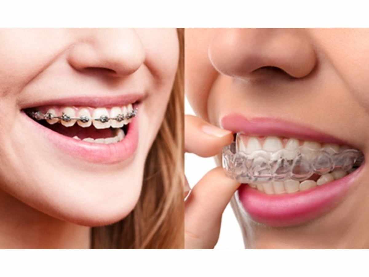 What is the average cost of braces in Carroll County?