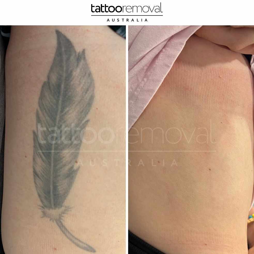 How Much Does Laser Tattoo Removal Cost in Gold Coast?