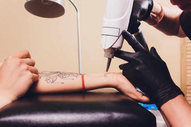 Why the Demand for Tattoo Removal Professionals Is Growing in Australia