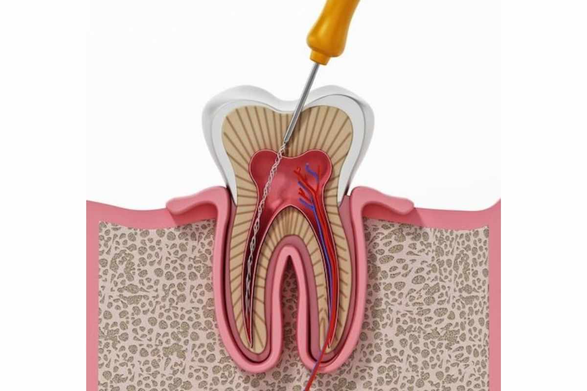 What Causes Root Canal Infection and How Can It Be Prevented?