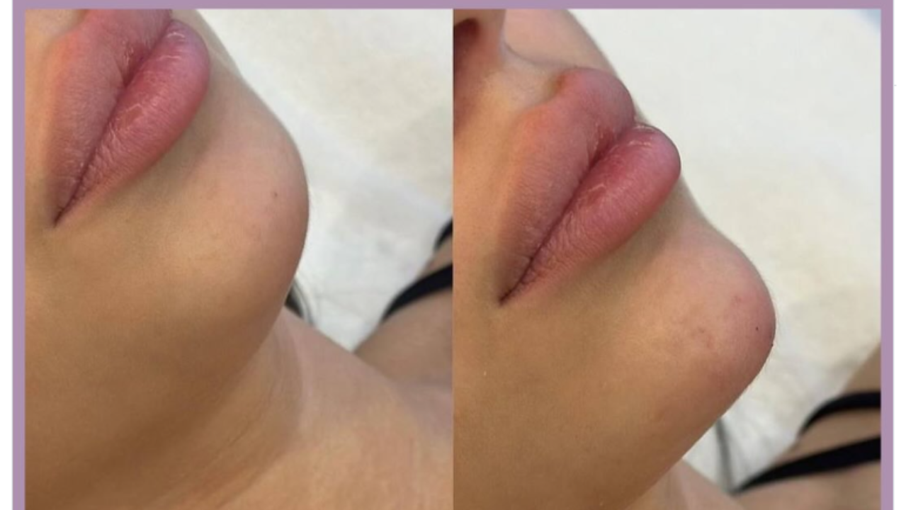 Is Lipfiller Right For You? A Practical Guide For Women In Enschede