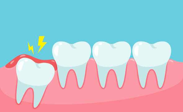 Delaying Wisdom Tooth Removal? Here’s What Your Mouth Might Be Facing