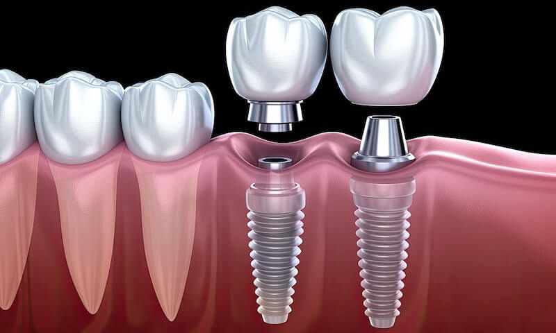 Still Chewing from One Side? Explore Dental Implants in Dhakoli