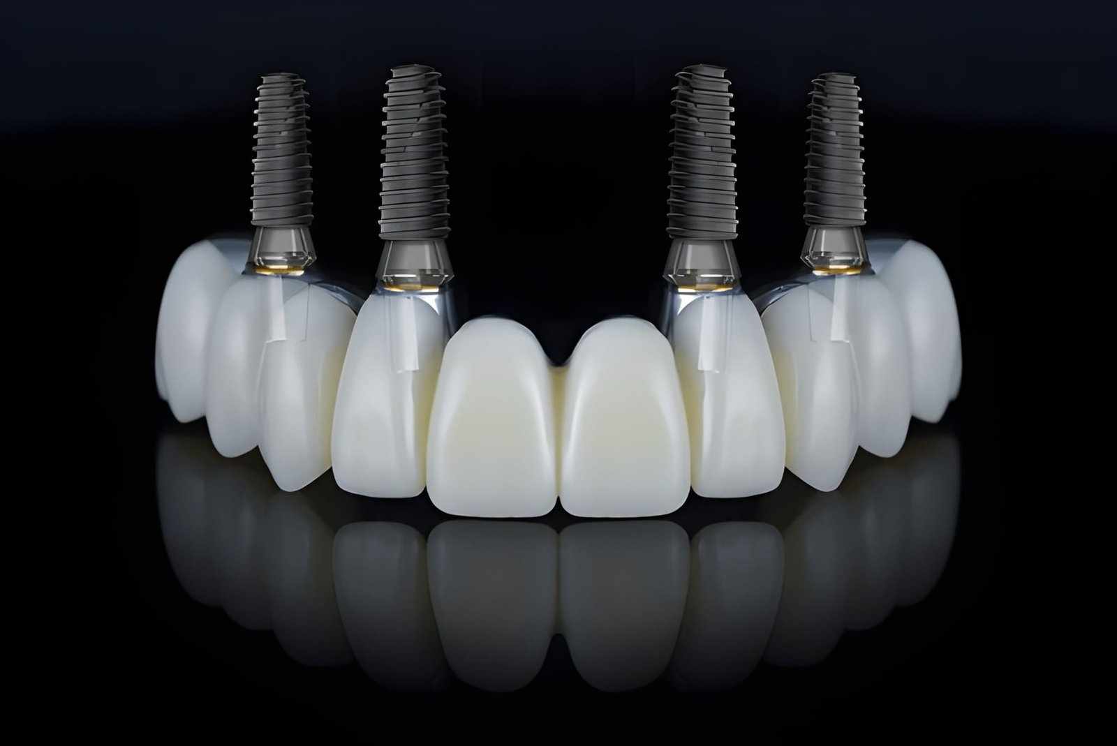 The Biggest All-on-4 Dental Implant Mistakes Patients Make and How to Avoid Them
