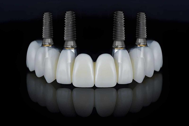The Biggest All-on-4 Dental Implant Mistakes Patients Make and How to Avoid Them