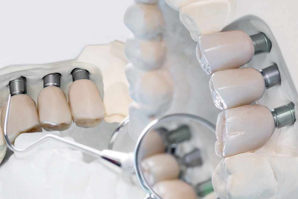 What Should You Know Before Choosing Dental Implants?