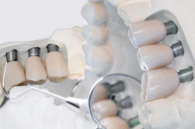 What Should You Know Before Choosing Dental Implants?
