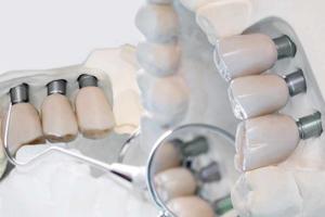What Should You Know Before Choosing Dental Implants?