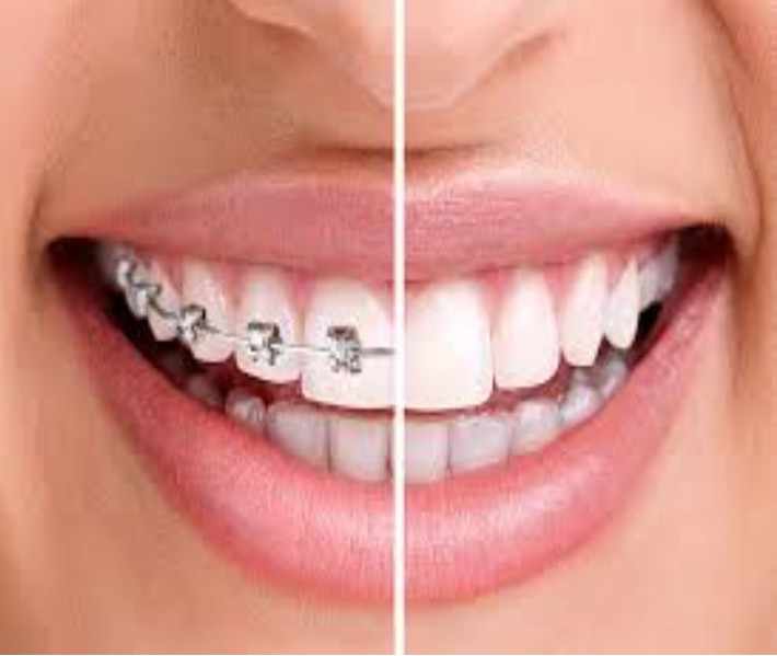 How Dental Braces Adelaide Can Improve Your Smile