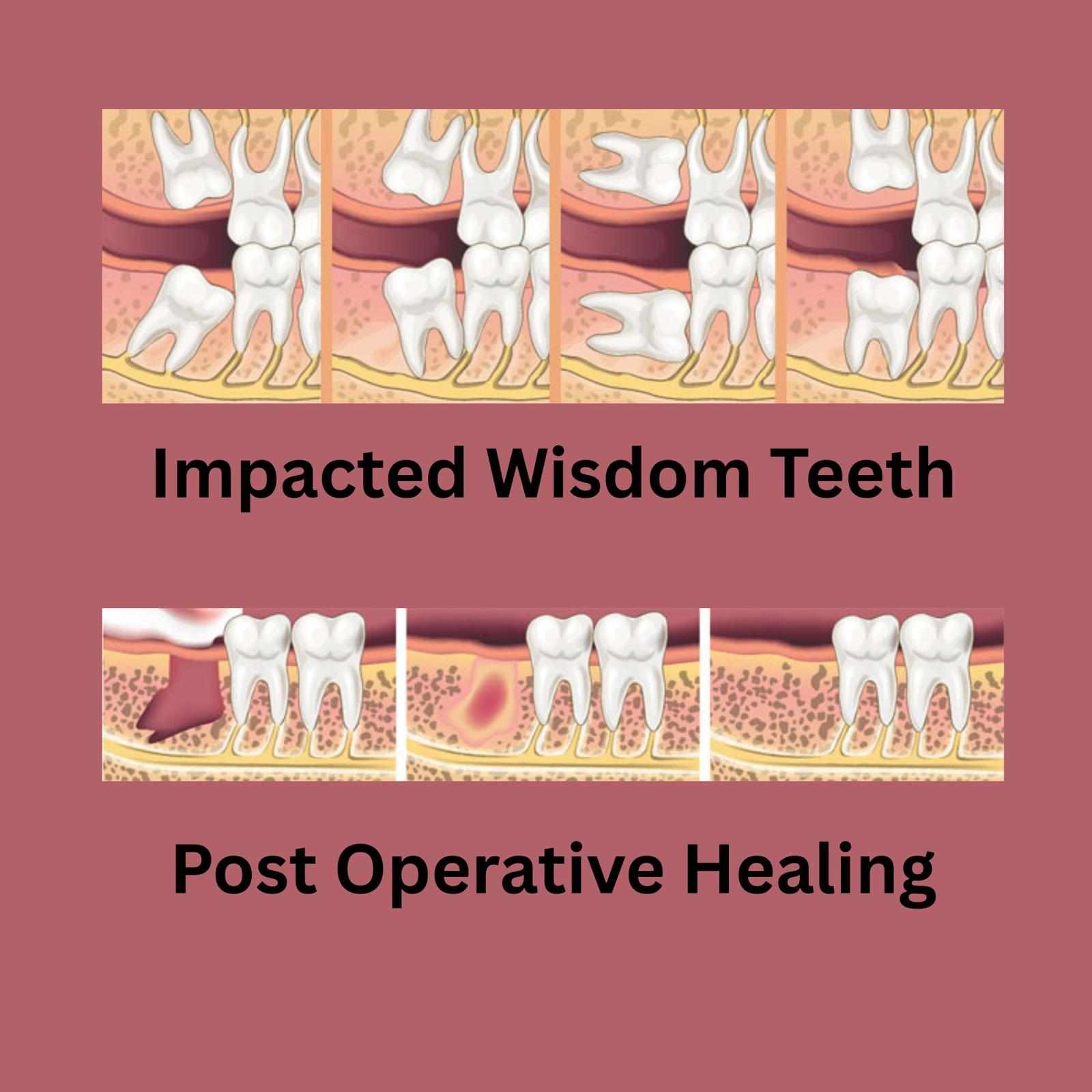 Wisdom Teeth Removal Adelaide: What Patients Should Know