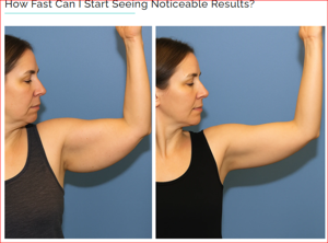 MyoGlow Arm Sculpting Device: Results Timeline What Users Can Expect During the First Week, First Month, and Beyond with Consistent Use
