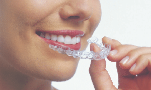 Clear Aligners Treatment in Bikaner: Straighten Your Teeth Without Metal Braces