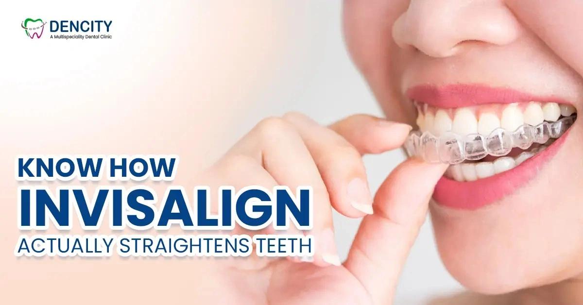 Best Dental Clinic for Invisalign in Bikaner: A Complete Guide to Invisalign Treatment
