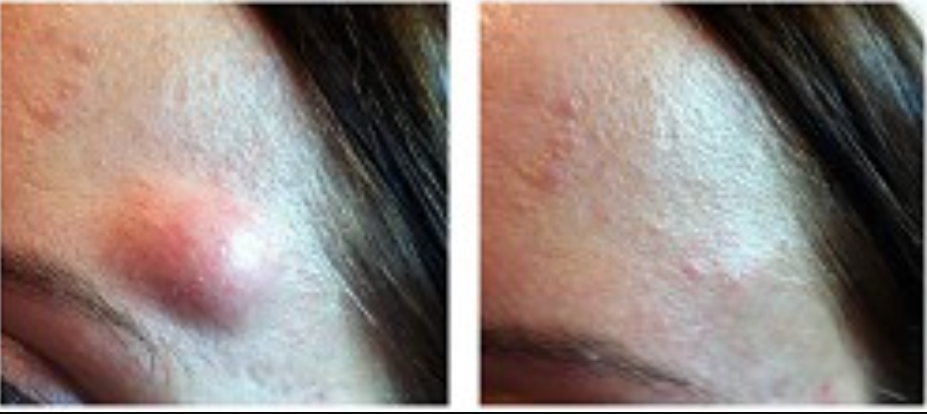 Dermatologist Richmond Guide: Lipoma Removal Cost vs Quality Across the UK