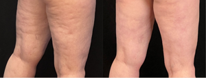 Cellulite Treatment With Avéli