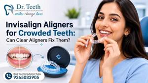Invisalign Aligners for Crowded Teeth: Can Clear Aligners Fix Them?