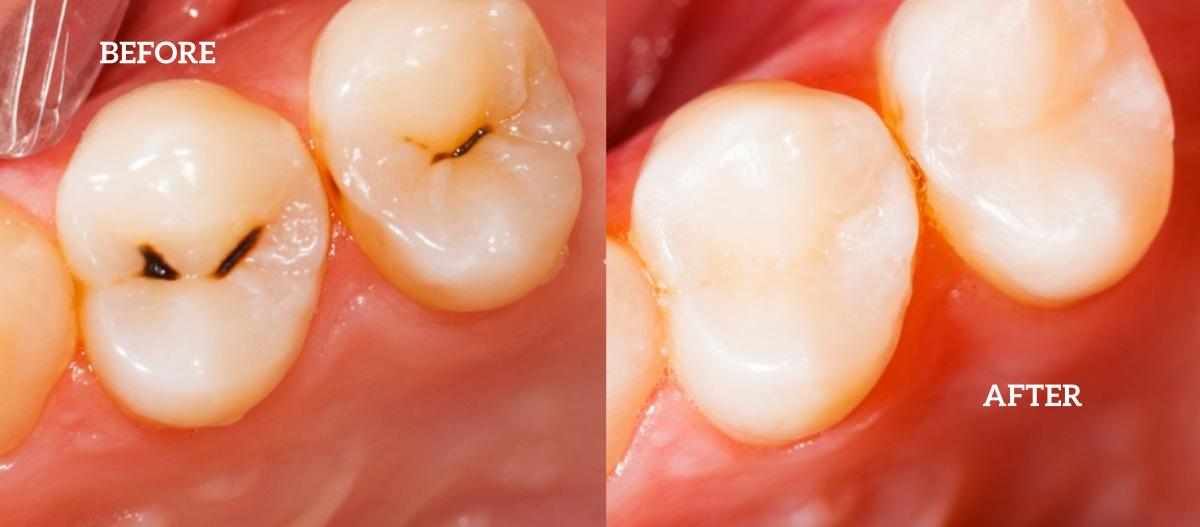 Silver vs White Fillings: Which One Should You Choose? | Forestside