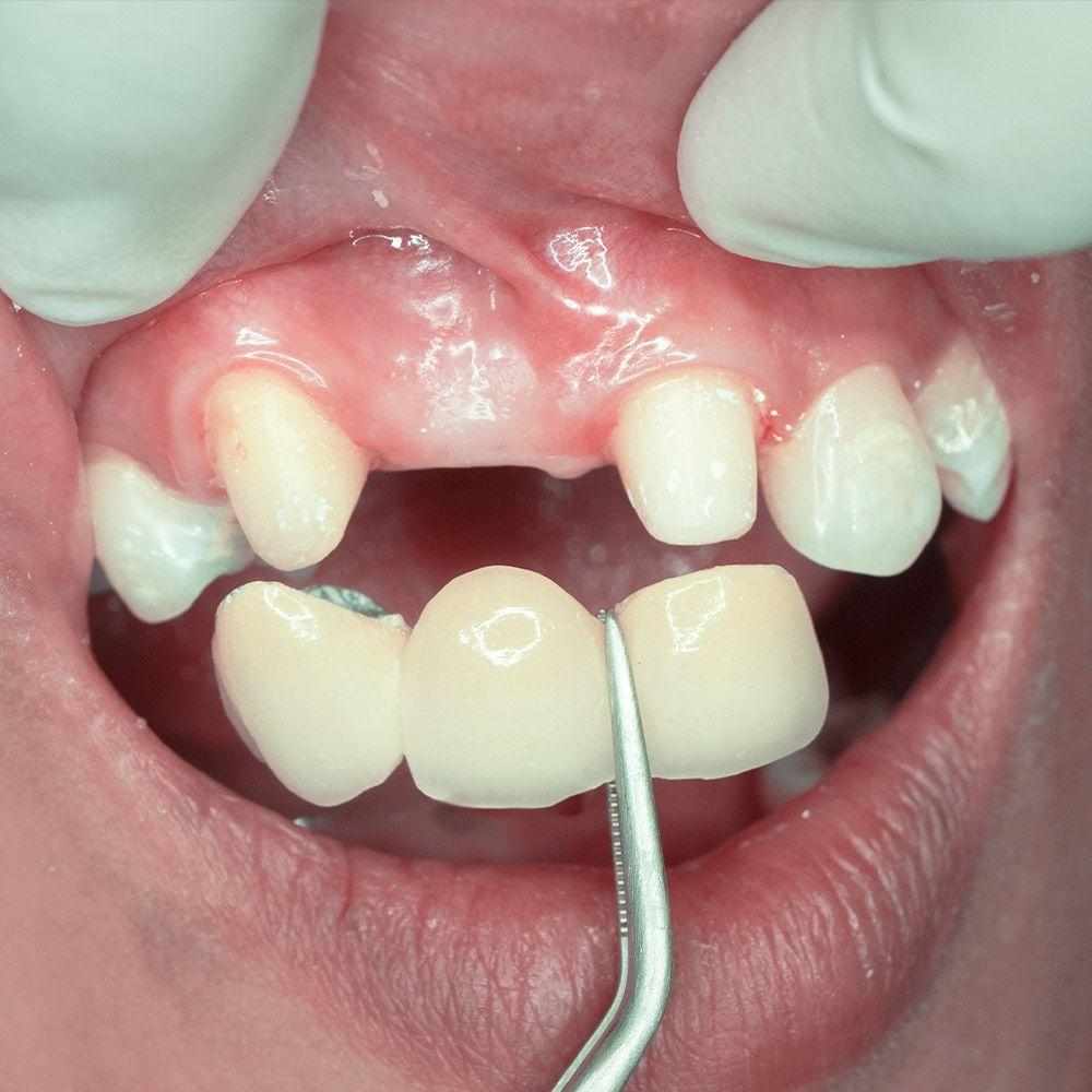 Dental Crowns Warsaw, IN - Tooth Crown - Dental Solutions
