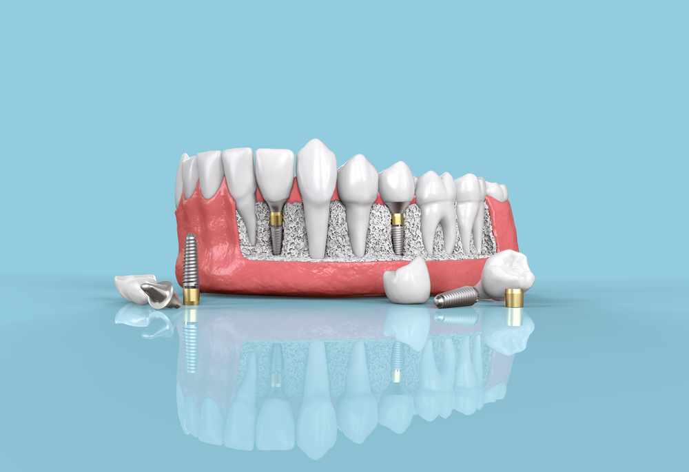 The Smiling Revolution: A Guide to Dental Implants for a Perfect Grin!