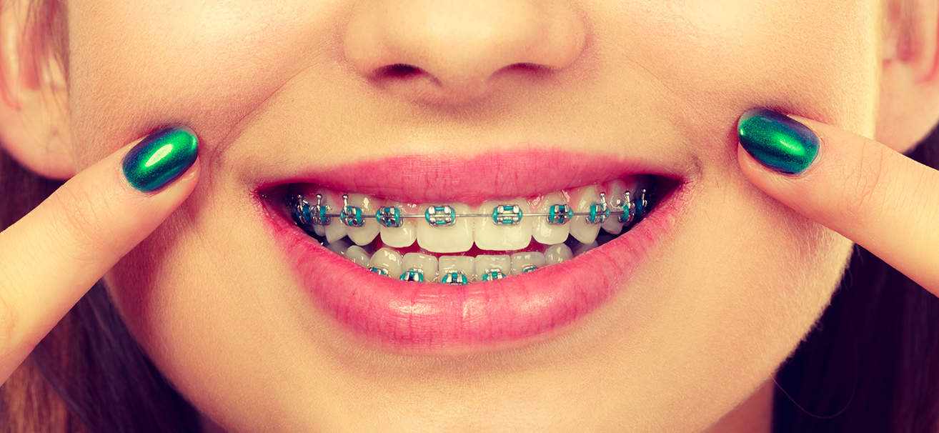 Braces Mesquite: Custom Orthodontic Treatment Giving a beautiful and healthy smile
